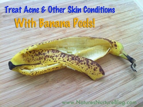 banana peels for acne