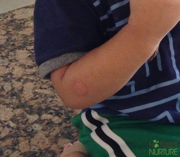 Eczema in Toddlers