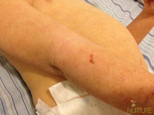 Eczema in Toddlers